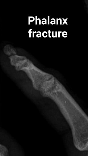 A transverse fracture involving the distal phalanx of the right index finger