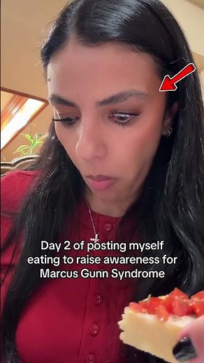 Marcus Gunn syndrome is a rare condition some people are born with where the nerve that controls the