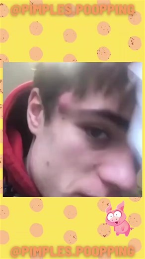 #foryou #viral #fyy #puntosnegros #puntosnegrosencara #acne #pimple #pimplepop #blackheadsss #satisfying #abcess #cyst #amsrsounds