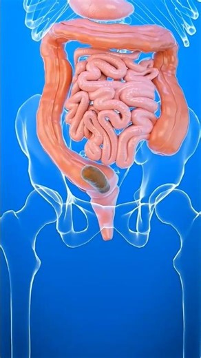 In this video, you will know about Poop Blocks Your Intestine.