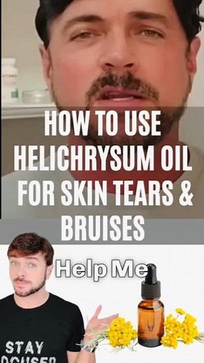 Cure Bruises and Varicose Veins With This Natural Oil