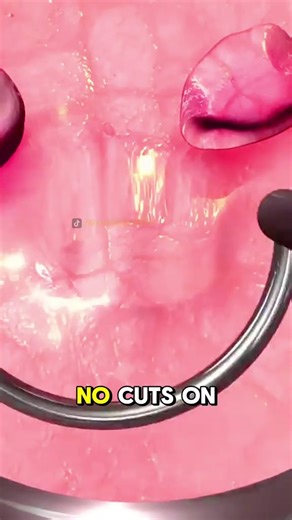 4.2K views · 42 reactions | Bladder Cancer Treatment Options (3D Animation) #bladder #cancer #bladdercancer #treatment #cancertreatment #therapy #intravesical #medicine #radiation #radiationtherapy #surgery #cancersurvivor #medical3danimation #3dmedicalanimation | Surgery Page | Facebook