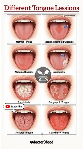 Tongue Diseases and Lesions Explained | Signs You Should Not Ignore | Oral Health Guide #healthylife