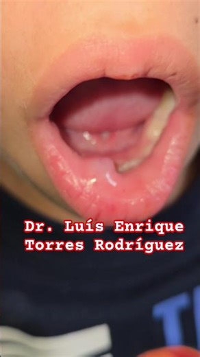 MUCOCELE LABIO INFERIOR