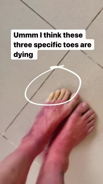 Understanding Raynaud's Phenomenon in Dermatology