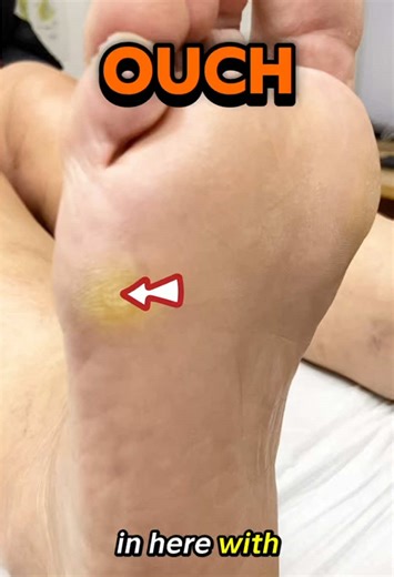 Effective Hard Corn Removal for Foot Pain Relief