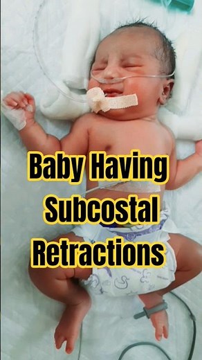 Baby Having Subcostal Retractions| #respiratorydistress #viralshortvideo #shortvideo