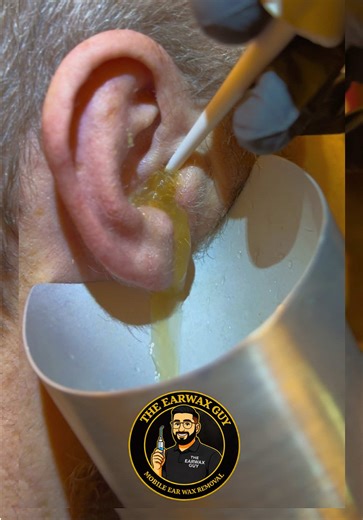 Discover the Color Change in Ear Wax Removal