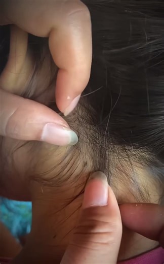 Catando Piolhos com Relaxante