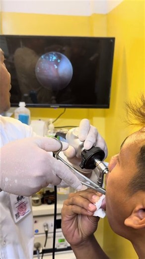 🐟 This Sharp Fish Bone Was Carefully Removed by the Doctor! #fishbone #medical #shorts