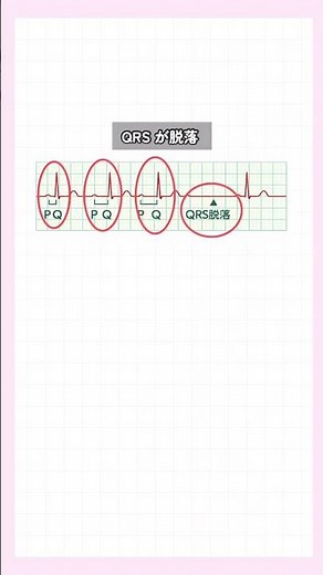 【今さら聞けない！房室ブロックって？】#医療#消化器#外科#看護#看護師#看護師2年目#新人看護師 #看護師勉強垢 #心電図 #房室ブロック