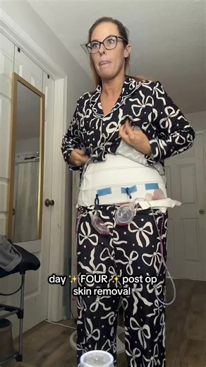 4 Days Post Panniculectomy Update: Healing Progress