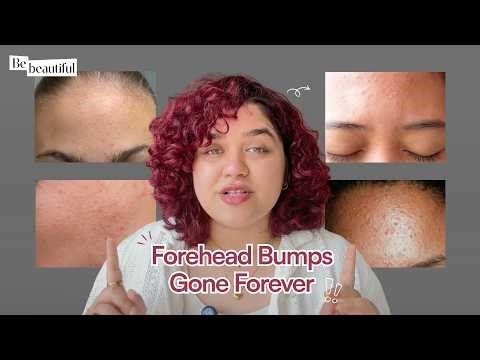 Forehead Bumps & Texture? Here's How to Fix It | Simple Skincare Routine | BeBeautiful