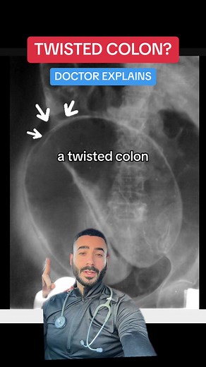 What happens when a colon gets twisted #greenscreen #greenscreenvideo #learnontiktok #learnwithtiktok #medical #health