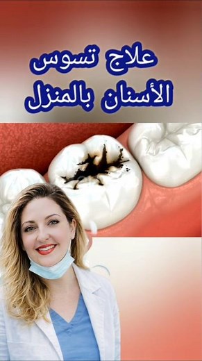 علاج تسوس الأسنان بالمنزل بدون طبيب !