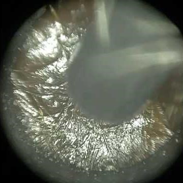 247 - Grade 3 Ear Wax Removal using the WAXscope®️ #earwaxremoval
