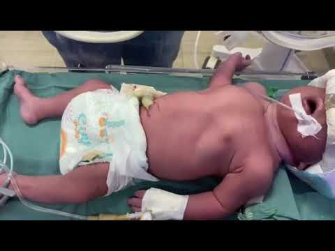 Subcostal retractions, neonate at NICU #pediattricsiseasy