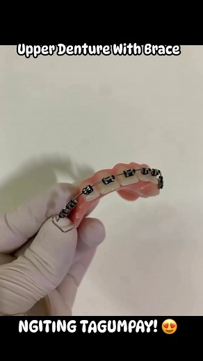 857K views · 6.4K reactions | Upper Denture With Brace!!! | Denture Denture | Facebook