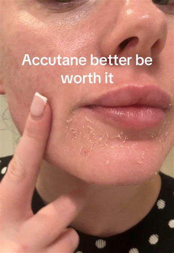 How long does this phase of dry skin last?! #accutane #dryskin #peelingskin