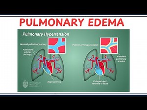Pulmonary Edema – Causes, Symptoms, Diagnosis and Treatment