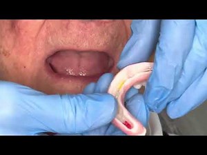 Digital Dentures: Upper Milled Complete Denture - Lower 3D Printed Bar OverDenture