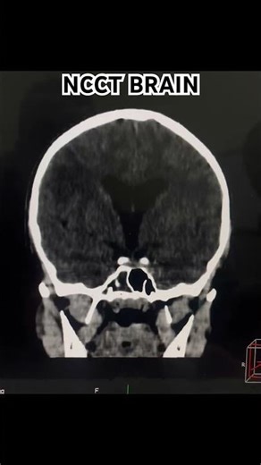 HYPERDENSE LESION WITH SURROUNDING MILD PERLESIONAL EDEMA IN LEFT THALAMUS…#ctscan #radiology