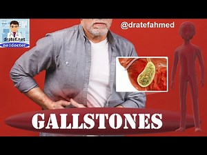 Gallstones/ Cholelithiasis / Causes /Symptoms /Diagnosis /Trea...