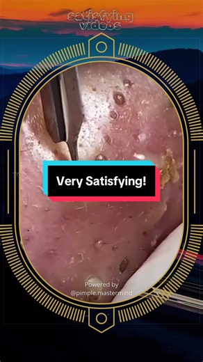 Blackheads removal at SPA Skincare Satisfying Video #blackheadsremoval #blackhead #acnetreatment #skincare #satisfying