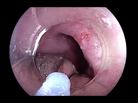 Dual-scope–assisted endoloop resection of a giant esophageal fibrovascular polyp