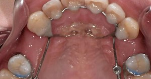 Lawsuit claims dental device damaged patients' teeth