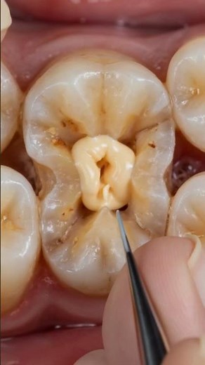 Cracked & Rotten Molar 😱 Deep Cavity Fixed in Seconds! #toothdecay #tooth #ytshorts
