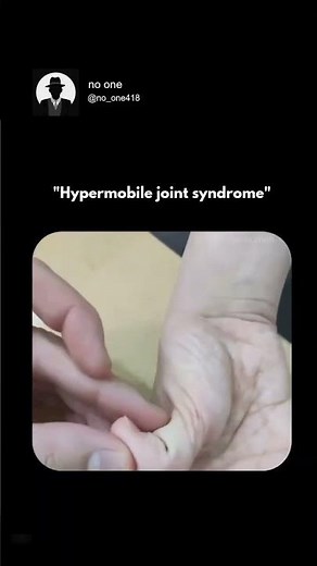 "Hypermobile joint syndrome"