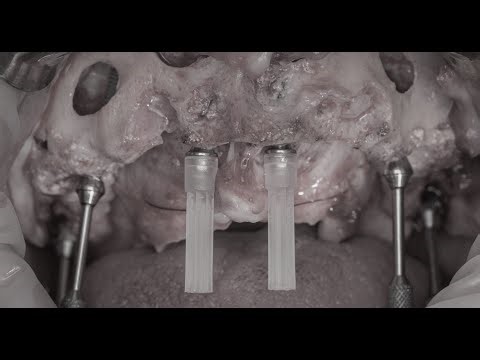 ALL ON 6 | Transsinus | Pterygoid Implants
