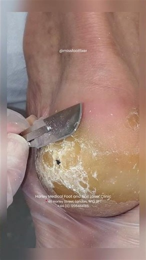 Did you know that when your skin detects repetitive friction