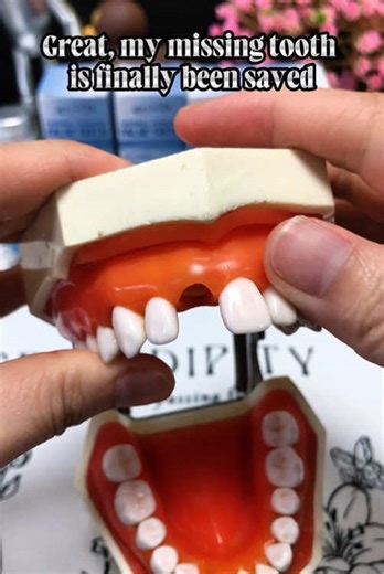 Great, my missing tooth is finally been saved#teethfilling #missingteeth #brokentooth #dentures #teethreplacement