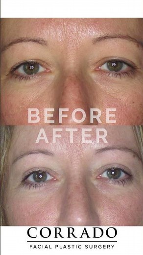 Eyelid Surgery (Blepharoplasty) Before & After Results | Dr. Corrado #shorts #cosmeticsurgery