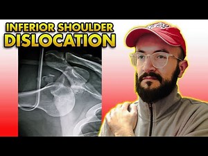 Inferior Shoulder Dislocation: Clinical Features, Imaging, Treatment & Complications