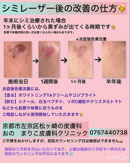 シミレーザー後の改善の仕方 炎症後色素沈着にはホワイトニングTAや白玉ペプチドなど👩‍⚕️
