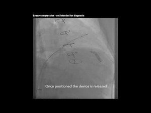 Leadless Pacemaker Insertion