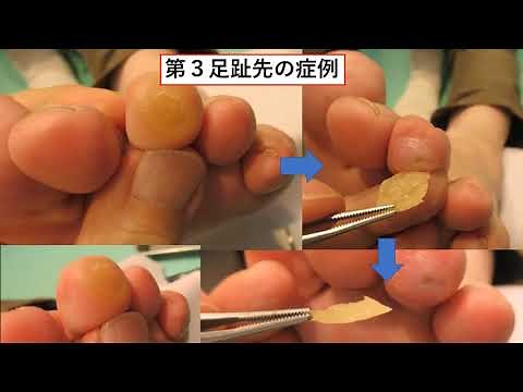 魚の目の当院での取り方