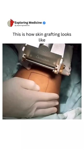 BIOLOGY | HEALTH | MEDICAL on Instagram: "A dermatome is used to harvest a thin strip of skin from a donor site by making a smooth, controlled cut at a specific thickness and width. After the skin is removed from the donor area, it is placed onto the wound, secured with stitches or staples, and covered with a dressing to help it heal. Dm for credit or removal 👏🏻🙏🏻 For educational purposes only…………. #viral #explore #biology #skingrafting #skin"
