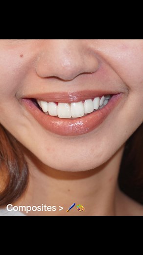 Composites > 🖌️🎨 #veneers