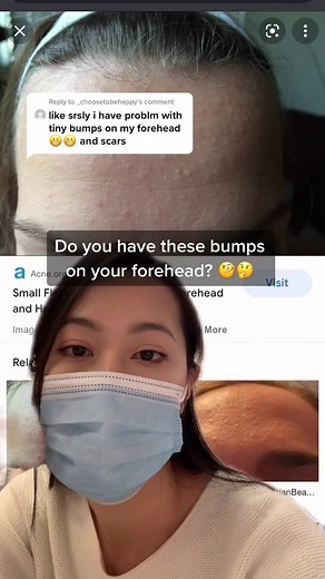 How to Get Rid of Bumps on Forehead | Korean Skincare Tips