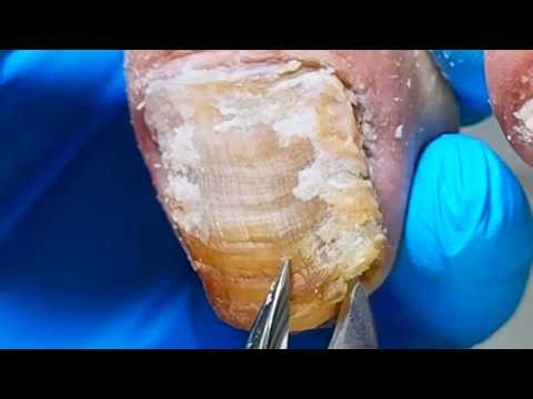 Thick Onychomycosis, Harder Than Stone【Xue Yidao】