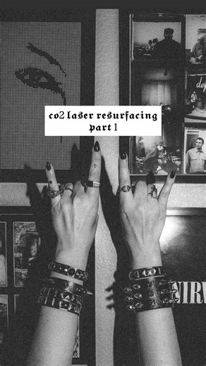 Indiefoxx on Instagram: "Taking you guys on my CO₂ laser resurfacing journey! ( I had a 5 min edited but IG told me that anything over 3 mins long will not be shown to newer audiences. So I cut 2 mins off. Full 5 min video will be on tiktok and YouTube) I’m really into skincare and staying as young-looking as a vampire, so my next step in that journey is laser resurfacing. As I mentioned, I have a few scars and want my smile lines softened. I also really want an overall better texture to my skin