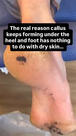 10K views · 4 comments | Thick callus on the heel and under the foot...