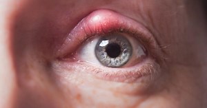 Ai făcut ULCIOR? Iată cum poţi scăpa RAPID de el