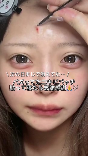 ニキビパッチの効果的な使い方とおすすめ商品