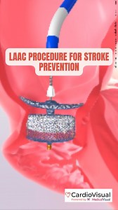 When clots form in the heart’s left atrial appendage, they can travel to the brain and cause a stroke. The LAAC procedure helps seal off this danger zone, especially crucial for those who can’t take blood thinners long-term. In South Asians, where AFib-linked strokes strike earlier and harder, LAAC can truly be life-saving. 🎥 Watch the video to understand how this procedure works and who it helps. #StrokePrevention #LAAC #AFibAwareness #HeartHealthMatters #SouthAsianHealth #MedicalEducation #Ca