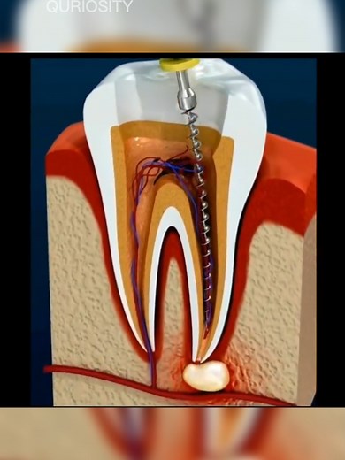 Cómo se realiza una endodoncia: guía completa